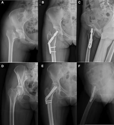 Comparison of femoral neck system vs. dynamic hip system blade for the treatment of femoral neck fracture in young patients: A retrospective study